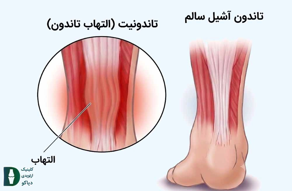 التهاب