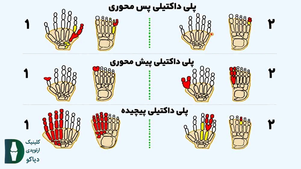 انگشت اضافه