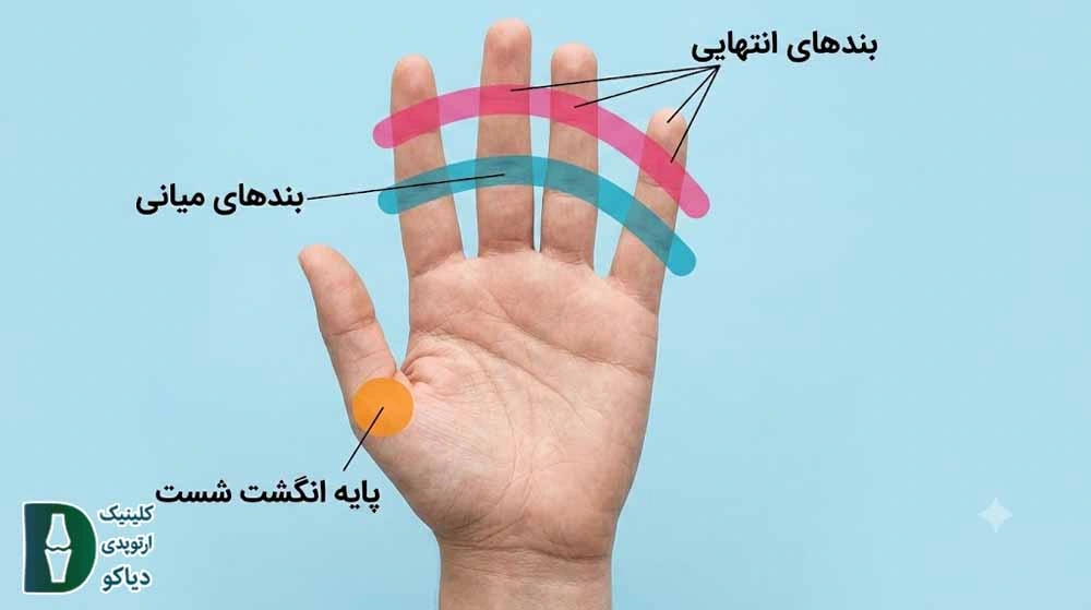 آرتروز انگشت