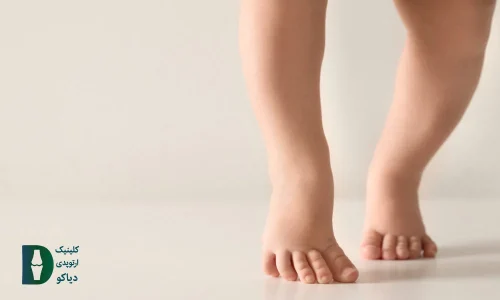 کوتاهی تاندون آشیل در کودکان