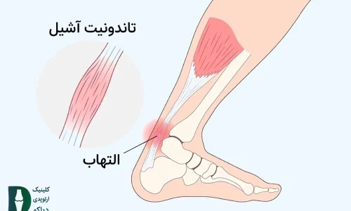 التهاب تاندون آشیل