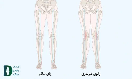 جراحی زانو ضربدری