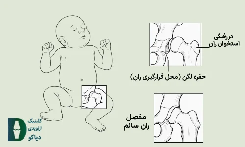 دررفتگی مادرزادی لگن