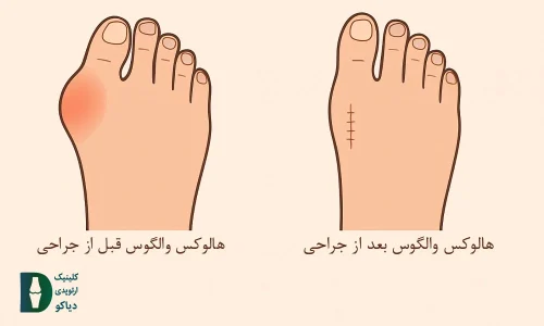 عمل هالوکس والگوس