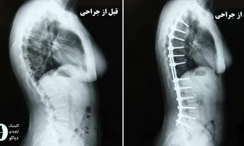 جراحی کیفوز