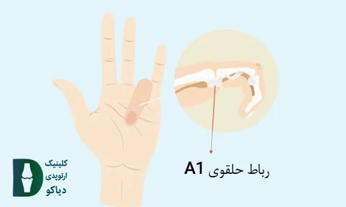 انگشت ماشه‌ای
